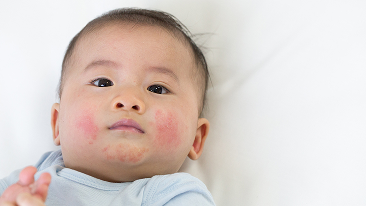 baby hives, baby boy with hives on his face