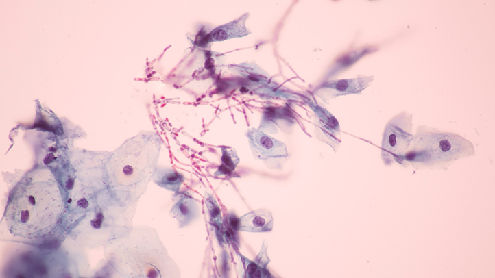 thrush and breastfeeding, medical image of thrush infection
