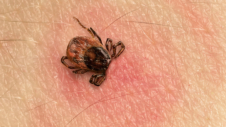 tick bites in children