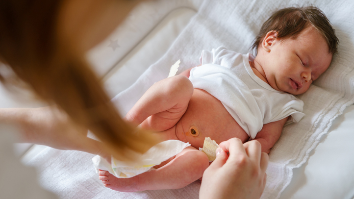 umbilical granuloma, woman caring for newborn baby's belly button